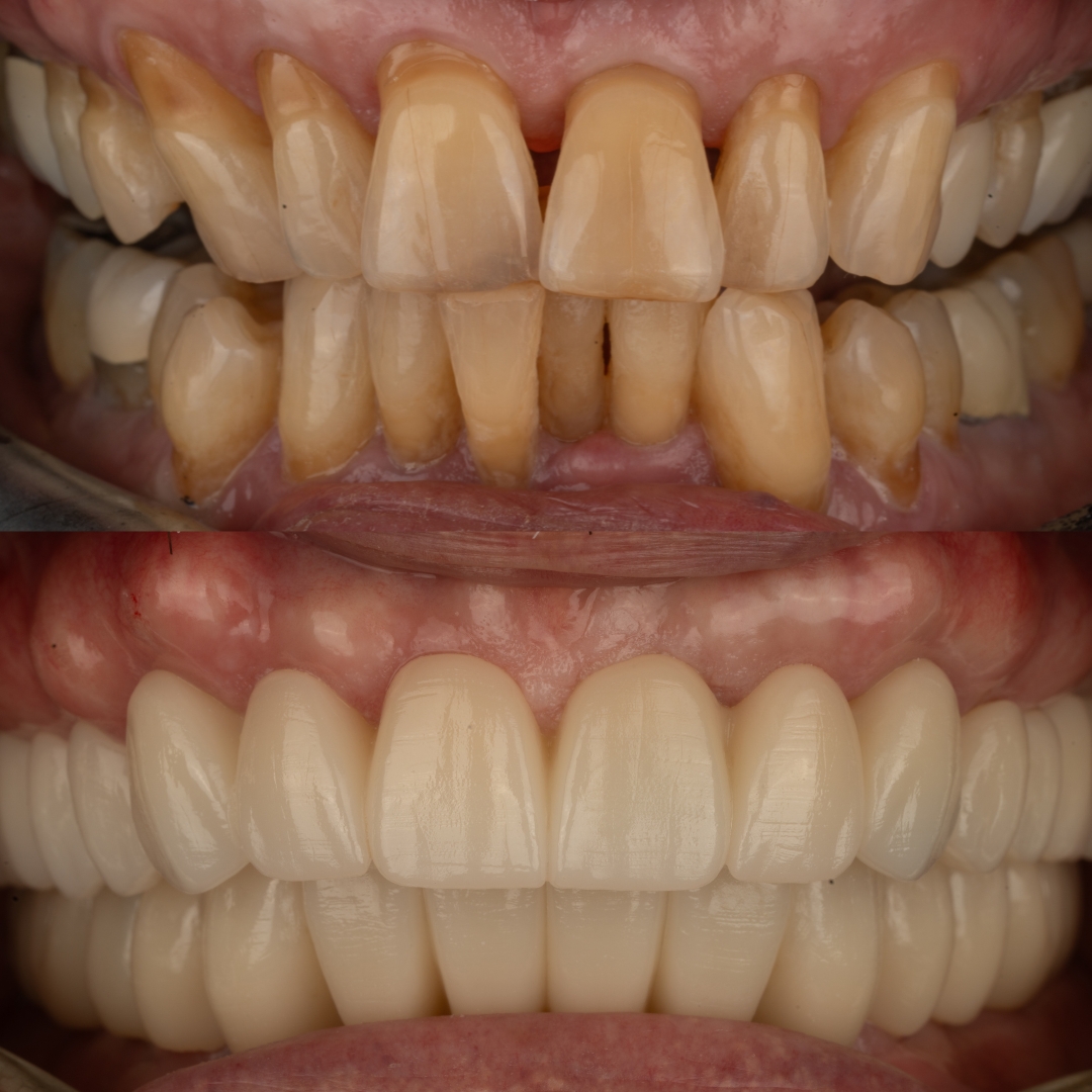 Before and after FP1 implant-supported bridge